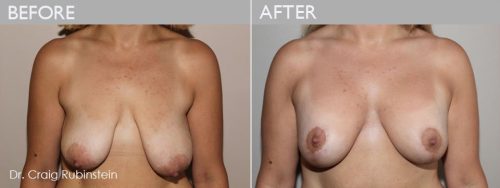 Uneven Breasts Asymmetry