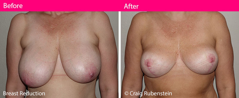 asymmetric breasts definition