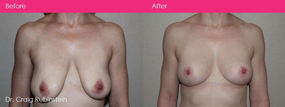 changing-nipple-size-shape-breast-reduction