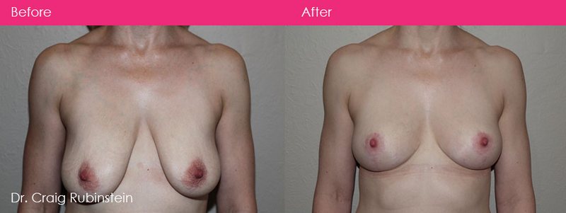 breast-lift-surgery-droopy-breasts-nipple-size