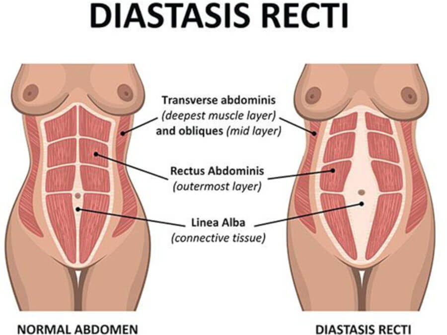 Repairing Tummy Muscles Post Pregnancy Abdominoplasty Diastasis Recti Abdomen Compared Image