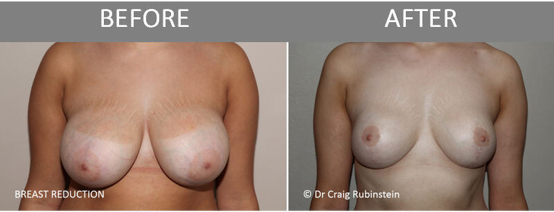 Breast reduction before after photographs Melbourne rubinstein Scaled Will Medicare Cover my Breast Reduction Surgery? - 2