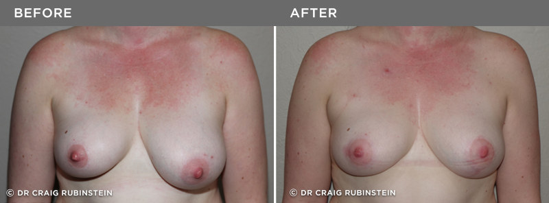 Dr Craig Rubinstein Before After Breast Reduction Will Medicare Cover my Breast Reduction Surgery? - 1