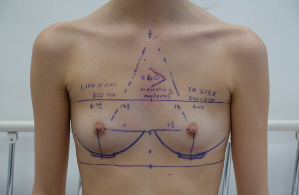 Pre-Surgery-Measurements-for-Breast-Implant-Size-Dr-Craig-Rubinstein
