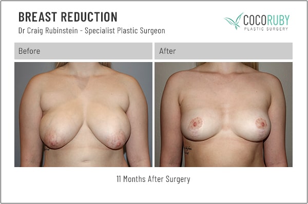 8 25 22 breast reduction dr craig rubinstein IDCR164 1 Breast Reduction Melbourne - 2